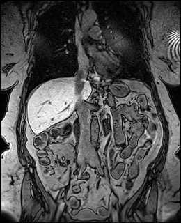 Coronal abdomen MRI