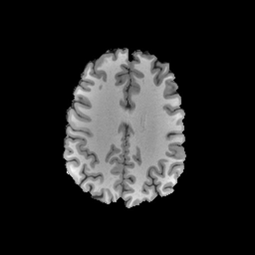 T1 MRI slice of the brain