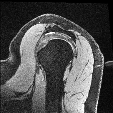 Original 3D MRI slice of the shoulder