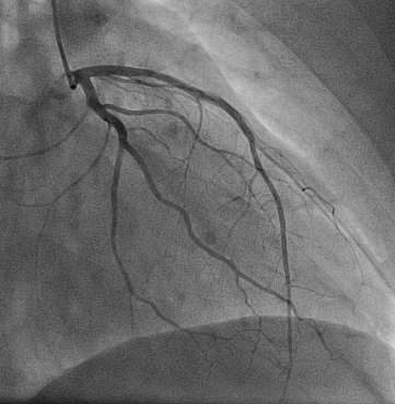 Recorded angiogram of the left coronary arteries