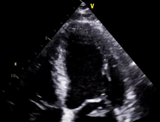 Grayscale echocardiogram with a flail posterior mitral leaflet