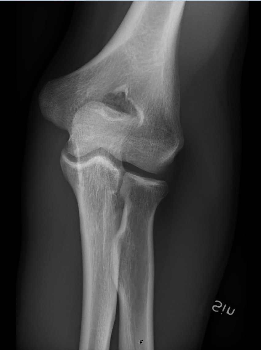 Radiograph of the elbow