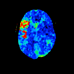 CT perfusion map with focal delay
